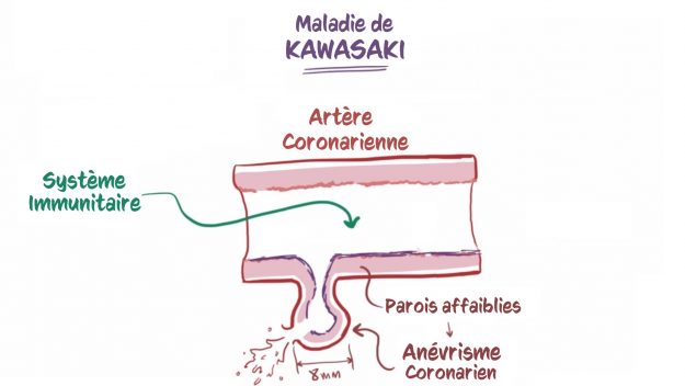 200521 - Schéma maladie de Kawasaki artères traduit de Open Osmosis - La Déviation